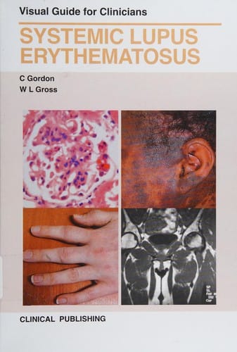 Systemic lupus erythematosus