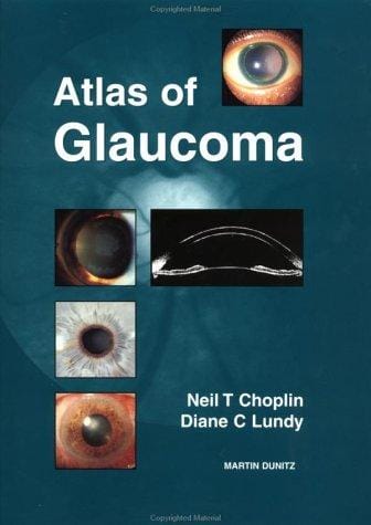Atlas of Glaucoma