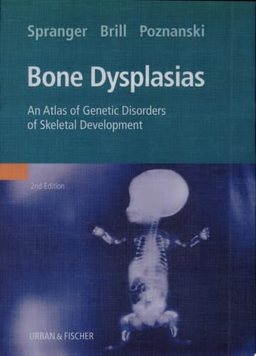 Bone Dysplasias
