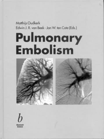 Pulmonary Embolism: Epidemiology, Diagnosis and Treatment