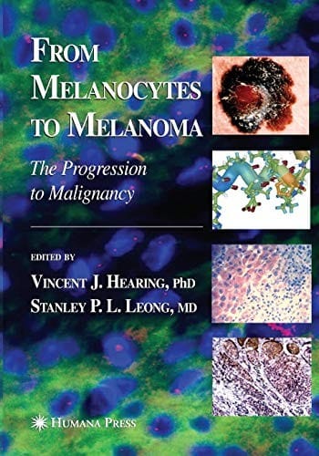 From melanocytes to melanoma