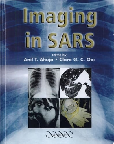Imaging in SARS