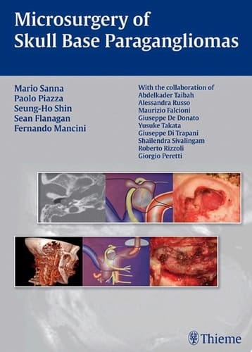 Microsurgery of Skull Base Paragangliomas