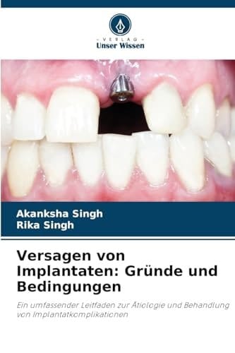 Versagen von Implantaten: Gründe und Bedingungen (German Edition)
