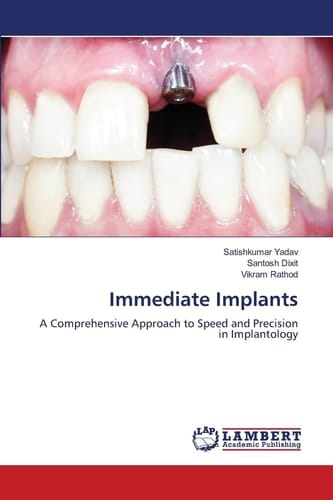Immediate Implants: A Comprehensive Approach to Speed and Precision in Implantology