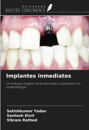 Implantes inmediatos: Un enfoque integral de la velocidad y la precisión en implantología (Spanish Edition)