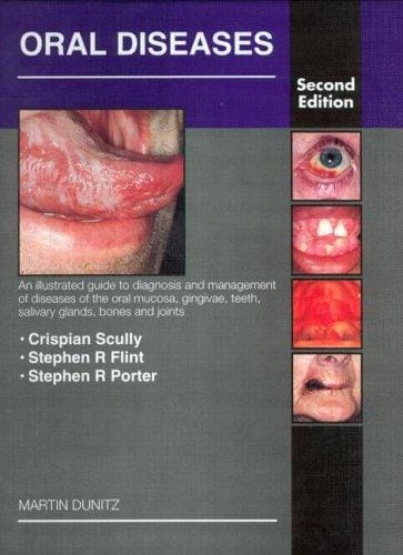 Oral diseases