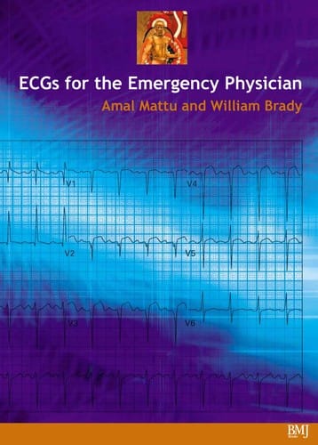 ECGs for the emergency physician