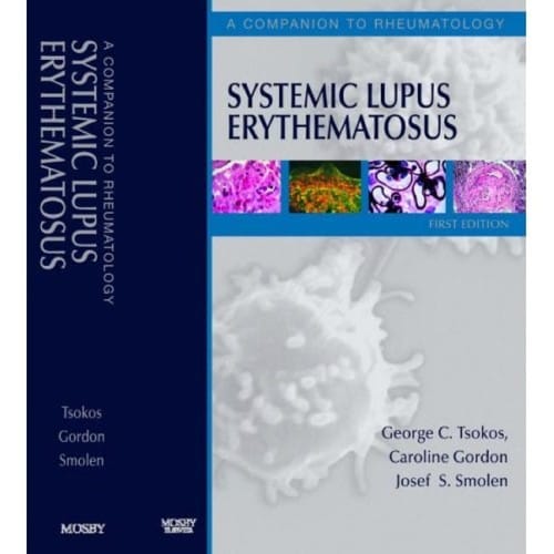 Systemic lupus erythematosus