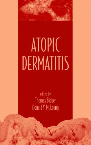 Atopic Dermatitis