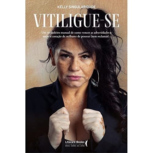 Vitiligue-se - um verdadeiro manual de como vencer as adversidades e tocar o coracao de milhares de pessoas (Em Portugues do Brasil)