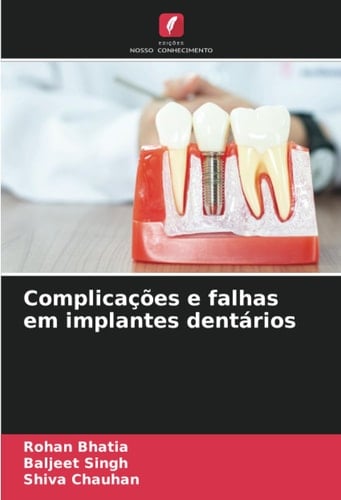Complicações e falhas em implantes dentários (Portuguese Edition)