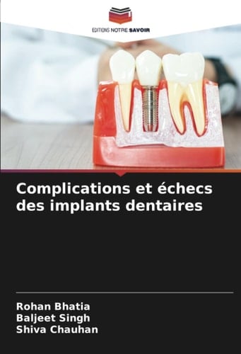 Complications et échecs des implants dentaires (French Edition)