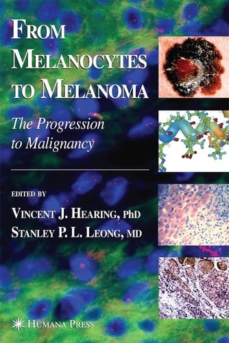 From Melanocytes to Melanoma The Progression to Malignancy