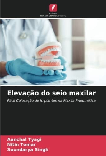 Elevação do seio maxilar: Fácil Colocação de Implantes na Maxila Pneumática (Portuguese Edition)
