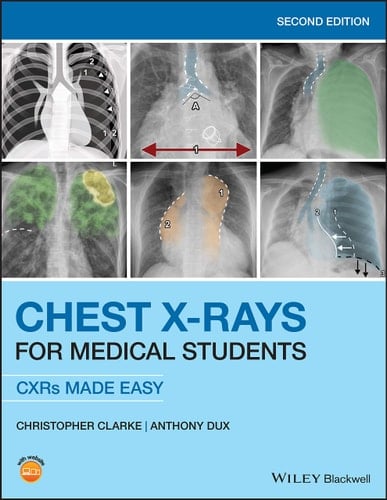 Chest X-Rays for Medical Students CXRs Made Easy