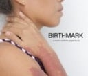Birthmark