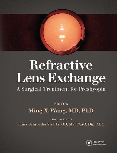 Refractive Lens Exchange A Surgical Treatment for Presbyopia
