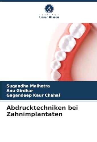Abdrucktechniken bei Zahnimplantaten (German Edition)