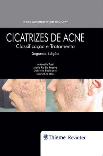 Cicatrizes de Acne: Classificação e Tratamento
