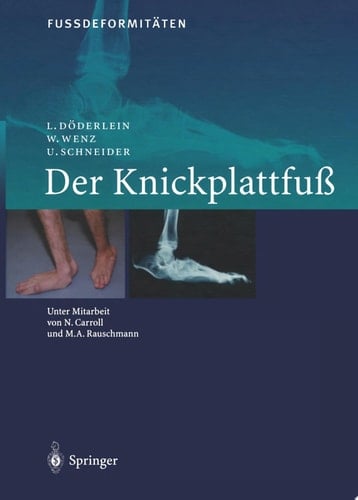 FussdeformitÄten Der Knickplattfuss