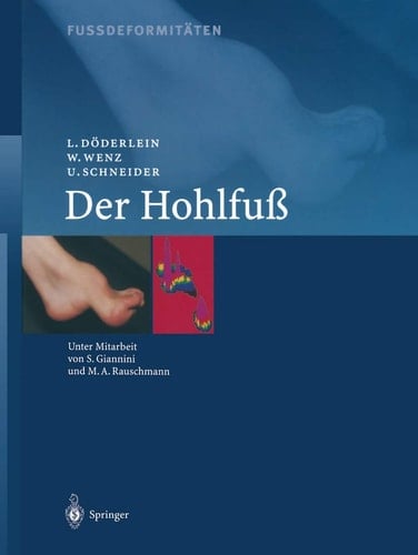 Fussdeformitäten Der Hohlfuss