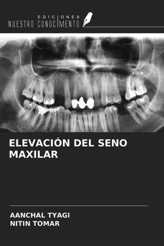 ELEVACIÓN DEL SENO MAXILAR (Spanish Edition)