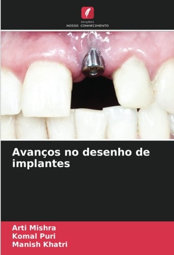 Avanços no desenho de implantes (Portuguese Edition)