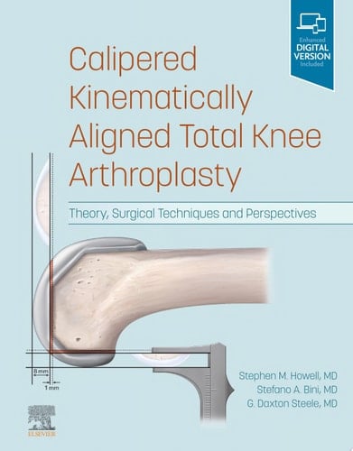 Calipered Kinematically aligned Total Knee Arthroplasty