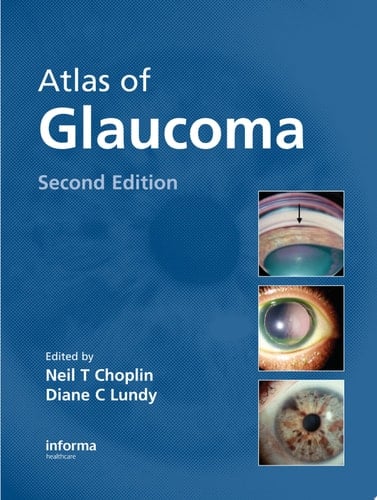 Atlas of Glaucoma