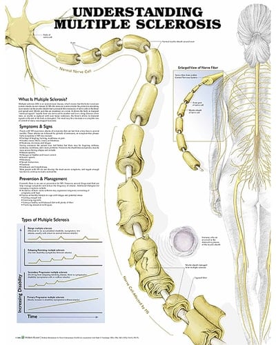 Understanding Multiple Sclerosis Paper