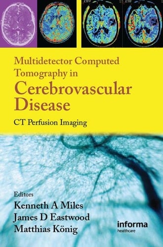 Multidetector Computed Tomography in Cerebrovascular Disease