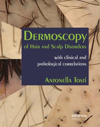 Dermoscopy of Hair and Scalp Disorders: With Clinical and Pathological Correlations