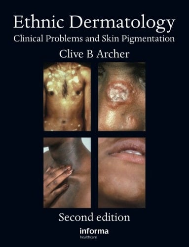 Ethnic Dermatology: Clinical Problems and Skin Pigmentation