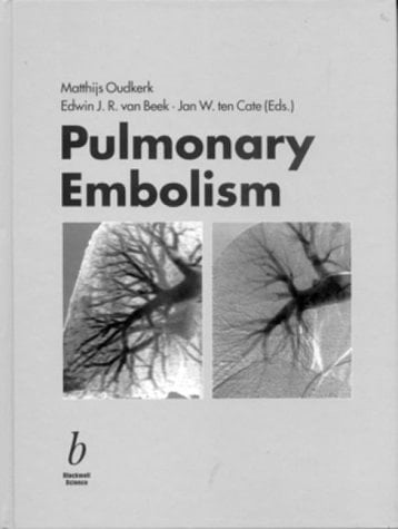 Pulmonary Embolism: Epidemiology, Diagnosis and Treatment
