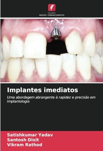 Implantes imediatos: Uma abordagem abrangente à rapidez e precisão em Implantologia (Portuguese Edition)