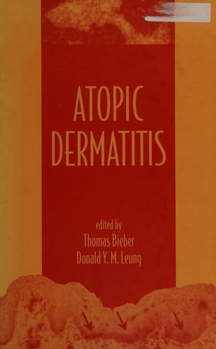 Atopic dermatitis
