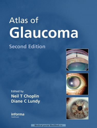 Atlas of glaucoma