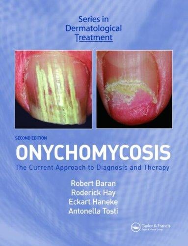 Onychomycosis