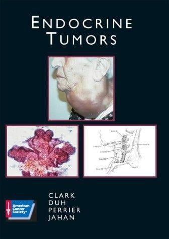 Endocrine tumors