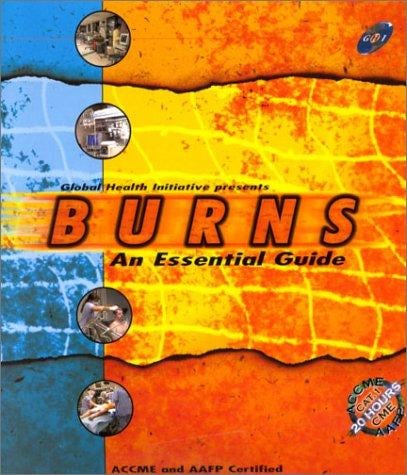 Burns