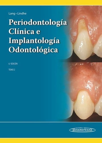 Periodontología clínica e implantología odontológica. Volumen 2 - 6. edición