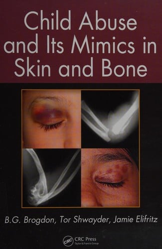 Child abuse and its mimics in skin and bone