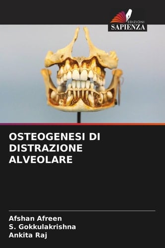 OSTEOGENESI DI DISTRAZIONE ALVEOLARE (Italian Edition)