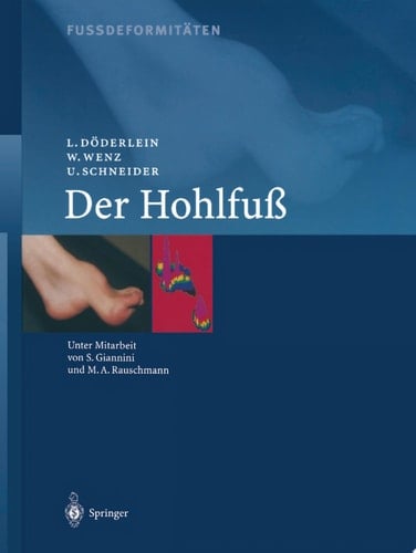 Fussdeformitäten Der Hohlfuss